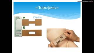 Пупочная грыжа у новорожденных - Что важно знать