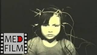Генерализованные эпиприпадки, лечение © EPILEPSY