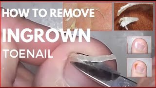 How to remove ingrown toenail. вросший ноготь на пальце ноги