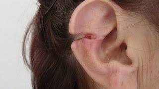 Ear Defect Repair // Как Правильно Зашить Ухо