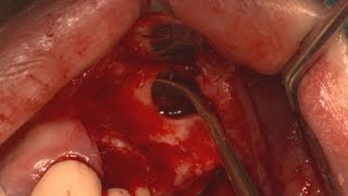Sinus elevation using DASK - Lateral approach -