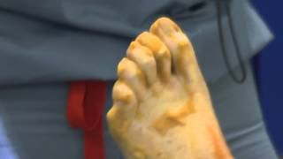 Nailing Down a Solution for Hammertoe