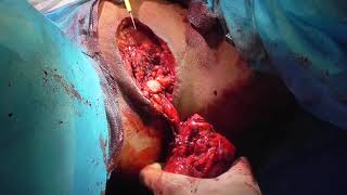 Total penectomy . 9 .7. 2019 .