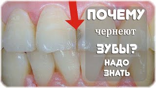 Почему чернеют зубы у взрослых?