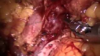 Robotic Surgery: Distal Pancreatectomy Spleen Preserving
