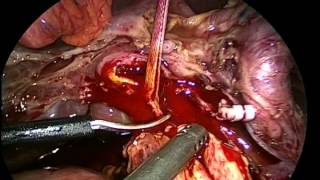 Totally Laparoscopic Whipple Procedure
