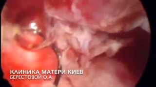 УЖАС ДИАГНОСТИЧЕСКИХ ГИСТЕРОСКОПИЙ И ВЫСКАБЛИВАНИЙ