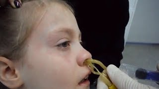 Лечение гайморита у детей. Реальное видео проведения ЯМИК процедуры девочке 8 лет.