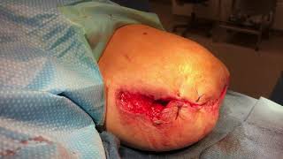 Above knee Amputation