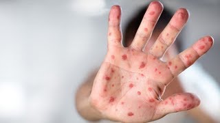В Сургут из Казахстана привезли корь