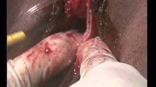 Complete vaginal uterine septum resection