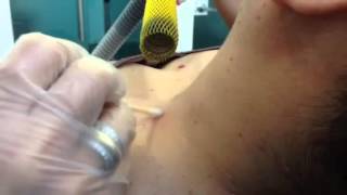 Remoción de lunares y verrugas con láser - Innova Laser Center