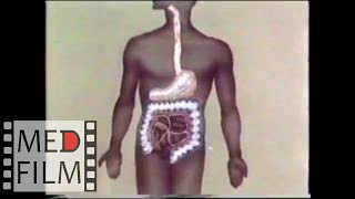 Хирургия ожоговых стриктур пищевода. Пластика пищевода © Treatment of burn esophageal strictures