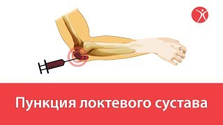 Пункция локтевого сустава в клинике Стопартроз