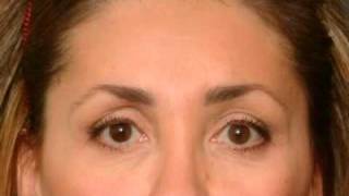 Natural Upper Eye Facial Rejuvenation - New Jersey - Dr. Mark Glasgold MD