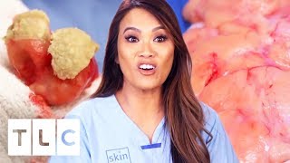 Non-Stop Pimple Popper Satisfaction! | Dr. Pimple Popper