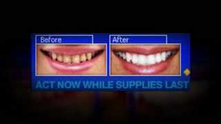 whitening teeth at home