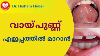 വായ്പുണ്ണ് മാറാൻ ഒറ്റമൂലികൾ | Mouth Ulcer Health Tips Malayalam
