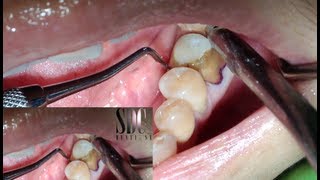 ครอบฟัน การทำครอบฟัน (Dental Crown)