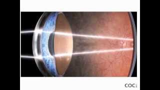 La Cornea