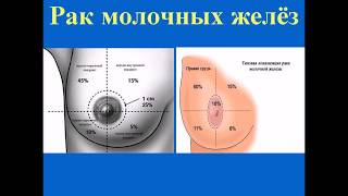 Рак молочной железы
