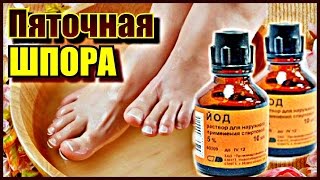 Эффективное НАРОДНОЕ лечение пяточной шпоры.