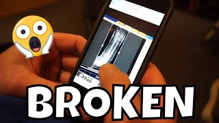 OWEN'S BROKEN ARM TRIP TO CHILDREN'S
