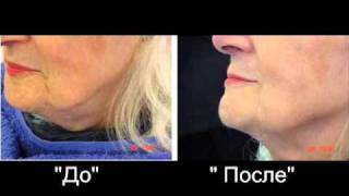 Леорекс. Маски для лица от морщин в домашних условиях.