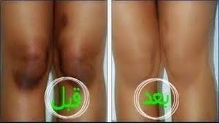 خلطة عشبية لتبييض الركب والاكواع في المنزل