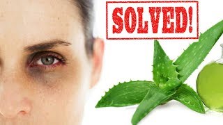 সহজ উপায়ে চোখের কালো দাগ দূর করুন (বাংলা) Remove your dark circle in this simple step[bangla]