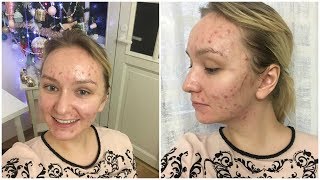 Пилинг при Акне! Виды Пилинга Которые Помогают