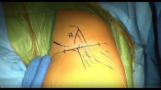 Chirurgie de la rupture totale des tendons ischio-jambiers  par Docteur Nicolas Lefevre