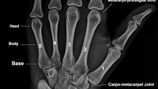 Bones of Palm - The Metacarpal Bones