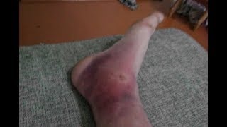 Не посоветую врагу! Перелом лодыжки со смещением.