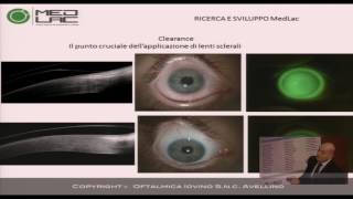 Marco Iovino,  Medlac - Approccio moderno all'applicazione di lenti sclerali - Convegno SOPTI 2017