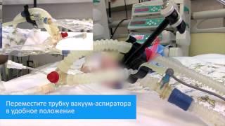 Санация трахеи новорожденных и детей с помощью закрытой аспирационной системы