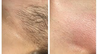 DIY Painless Sugar Wax At Home.(Ideal For Brazilian Waxing)
