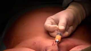 Penile Augmentation with Glans Augmentation