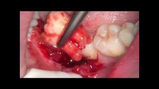 48 tooth extraction with microscop  (удаление зуба мудрости)