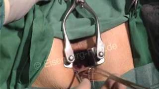 Lehrvideo: Hämorrhoiden OP - Anal OP - Hämoriden - hemorrhoid surgery