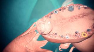Что такое киста яичника / What is an ovarian cyst
