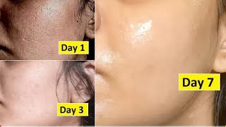Betnovate-C skin cream, शरीर पर दाग धब्बे खाज खुजली के लिए, how to remove face pimples,o tere ki