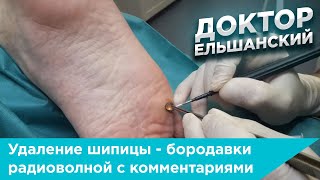 Удаление шипицы - бородавки радиоволной с комментариями врача