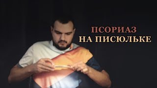 ПСОРИАЗ НА ПИСЮЛЬКЕ: ?симптомы ?лечение ?стадии ?бритьё ?секс