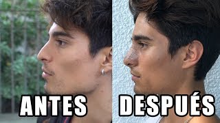 EL RESULTADO FINAL DE MI NARIZ DESPUÉS DE LA OPERACIÓN