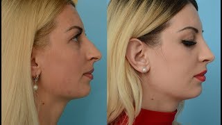 Моя РИНОПЛАСТИКА носа | До и ПОСЛЕ | Отзыв Марина