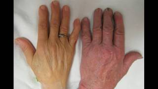 How to Recognize Symptoms of Vitamin D Deficiency