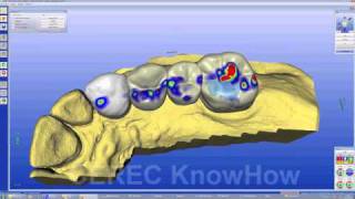 CEREC® Bridge Multilayer  - Bridge - Software