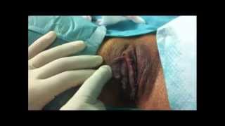 Nymphoplastie au laser par le Docteur Jacques Derhy