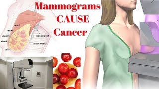 Mammograms CAUSE Cancer – The Best Prevention is Getting More of THIS Nutrient